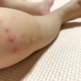 手足口病