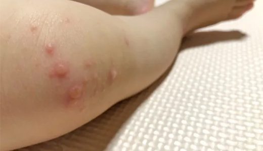 手足口病の予防と対策