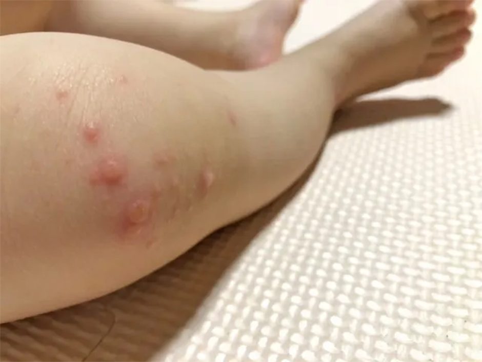 手足口病